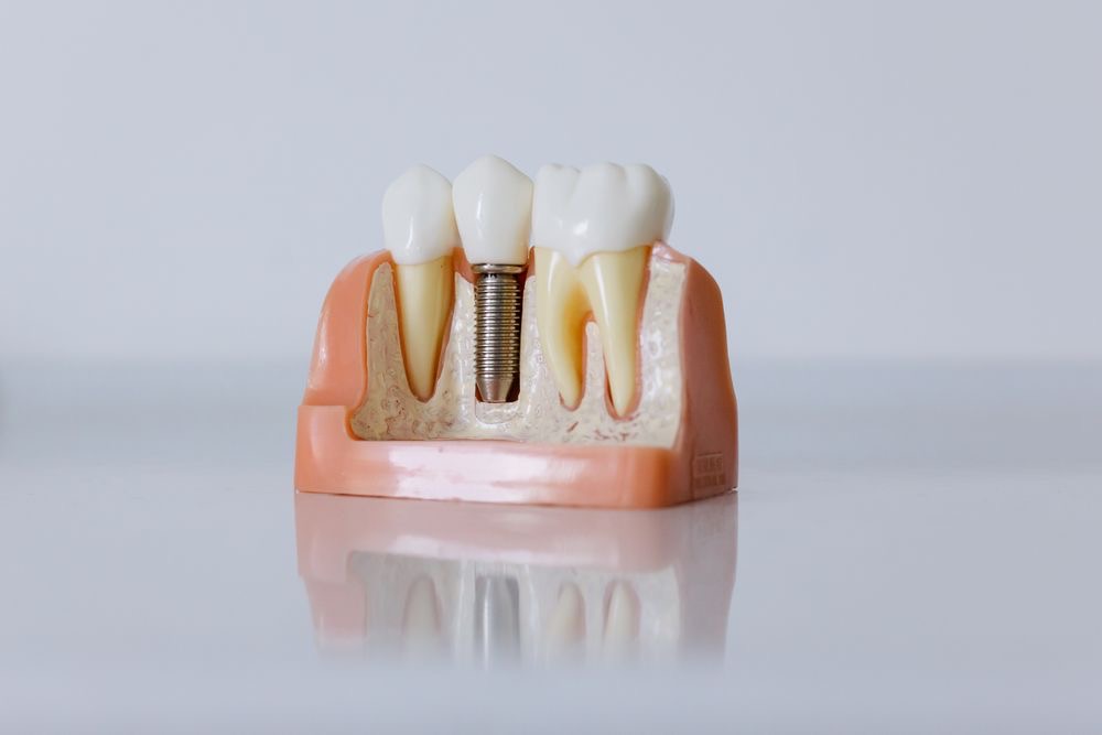 Implants you can trace
